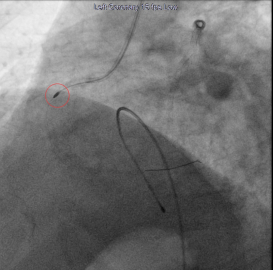 Elazığ'da kireçlenmiş damar tıkanıklarında rotablasyon tedavisi