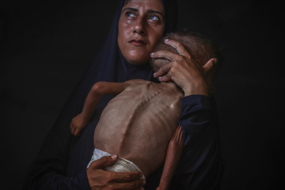 Filistinli bebek açlığın sembolü oldu, doktoru İsrail’in iddialarını çürüttü