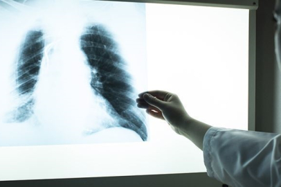 Sigara KOAH’a davetiye çıkarıyor