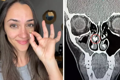 35 yıllık sır çözüldü: Burnundan çıkan şey doktorları bile şaşkına çevirdi