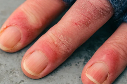 Soğuk ısırması sessiz tehlike