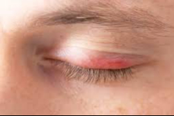 Göz kapağı iltihabına karşı doğal yöntemler