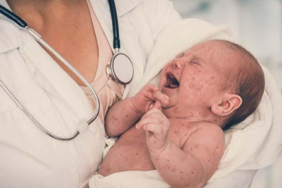 Su çiçeği vakaları Türkiye’de artıyor